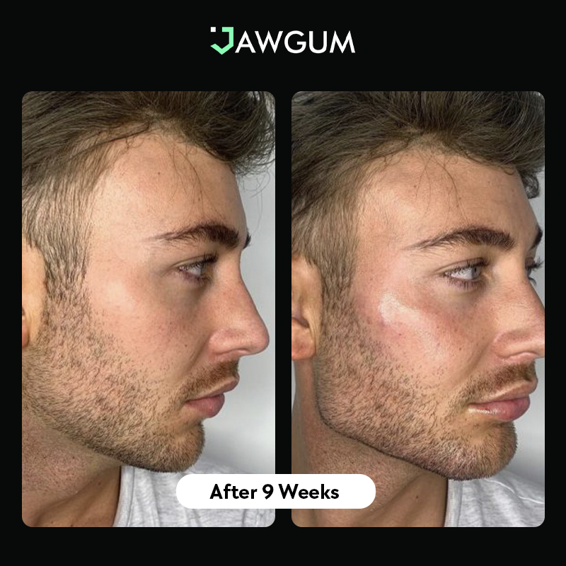 10 Chewing Gum Jawline Before and After Pictures – WOW!