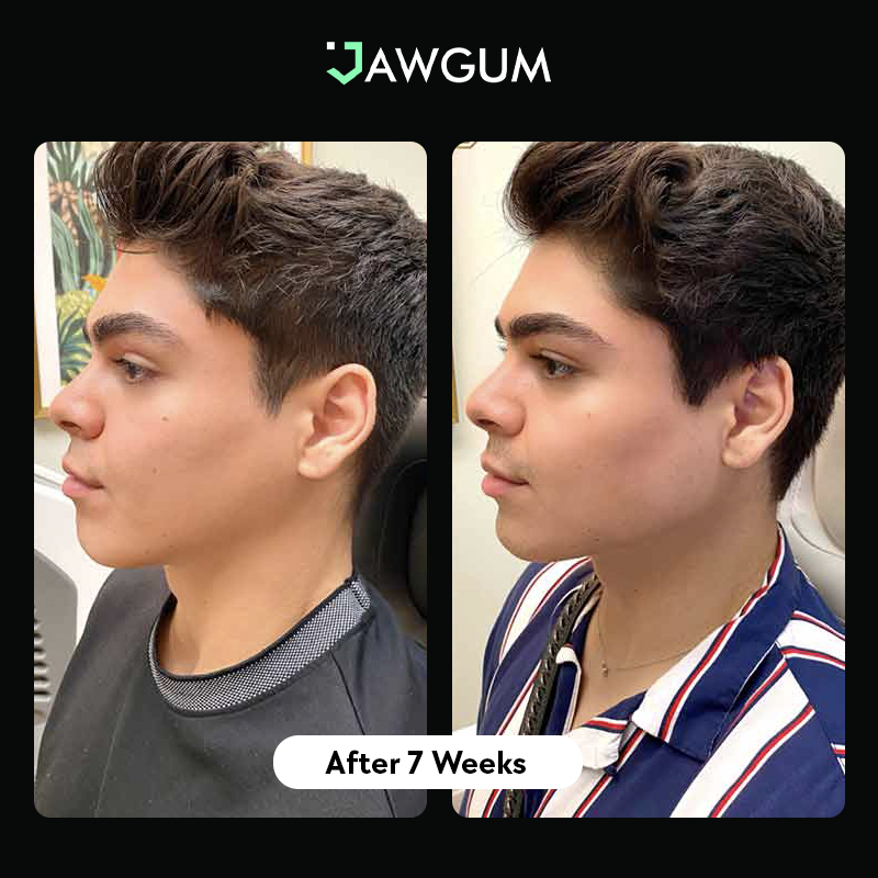 Jawline trainer before and after hot sale